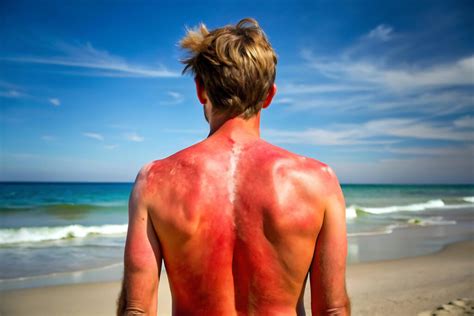 Ilustrácia správneho oplachovania popáleniny