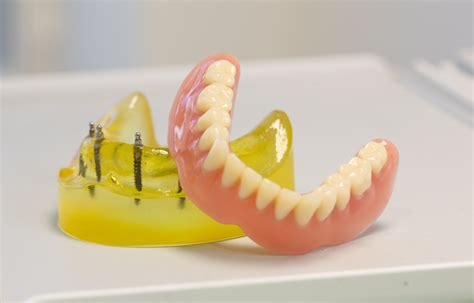 Porovnanie snímateľnej protézy a fixnej náhrady na implantátoch