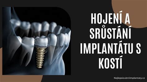 Diagram kochleárneho implantátu s vonkajšou a vnútornou časťou
