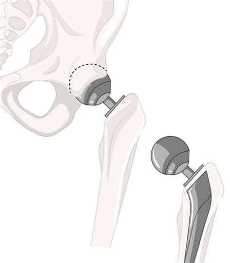 Schematické znázornenie procesu rehabilitácie po operácii bedrového kĺbu