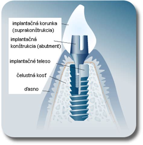 Ilustrácia zubného implantátu