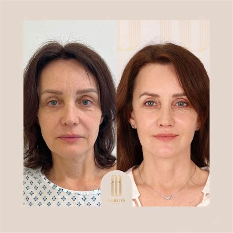 Diagram znázorňujúci vrstvy tváre pri facelifte