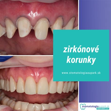 Zub pripravený na nasadenie korunky