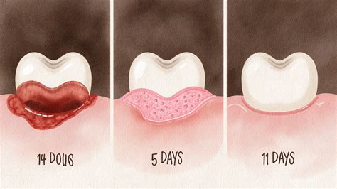 Infografika znázorňujúca fázy hojenia rany po extrakcii zuba