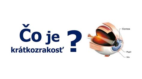 Diagram znázorňujúci princíp laserovej operácie LASIK