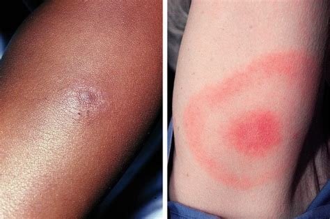 Ilustrácia erythema migrans na koži