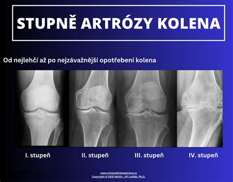 Ilustrácia artroskopického zákroku na menisku
