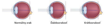 Diagram znázorňujúci priebeh laserovej operácie oka