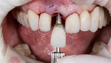 Zubná korunka na zube