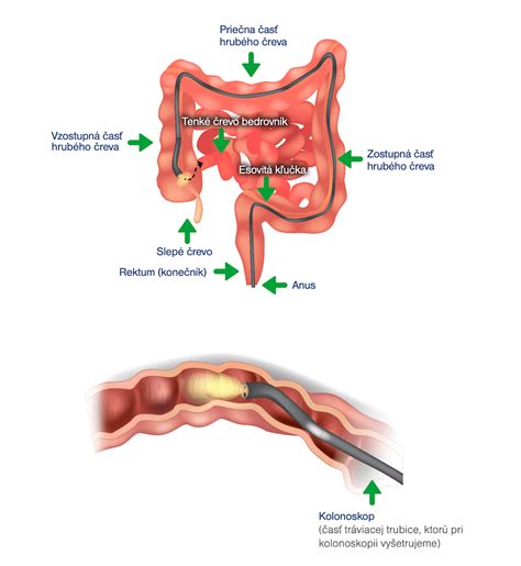 Diagram hrubého čreva s vyznačenými divertikulami