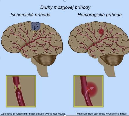 Diagram porovnávajúci ischemickú a hemoragickú mozgovú príhodu