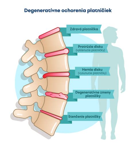 Schematické znázornenie chrbtice s vyznačenými medzistavcovými platničkami a stavcami