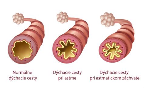 Ilustrácia priedušiek s príznakmi astmy