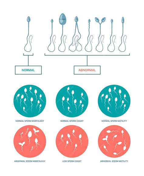 Diagram zobrazujúci rôzne tvary spermií (normálne vs. abnormálne)