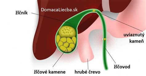Diagram znázorňujúci žlčové kamene blokujúce žlčovod