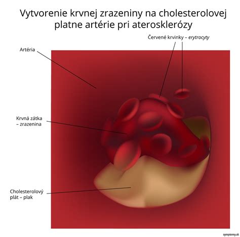 Ilustrácia krvnej zrazeniny v cieva