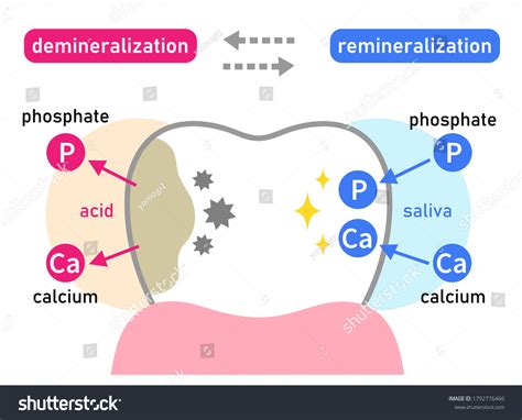 Diagram znázorňujúci demineralizáciu zubnej skloviny