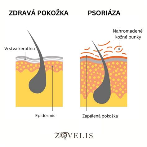 Ilustrácia zaparenín na pokožke