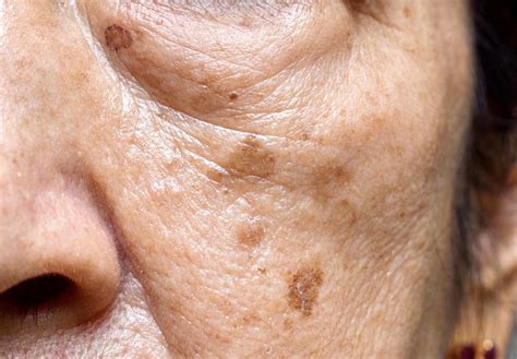 Rôzne typy hyperpigmentácie: lentigo solare, melasma, pozápalová hyperpigmentácia