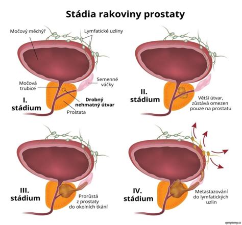 Ilustrácia chirurgického zákroku v oblasti penisu