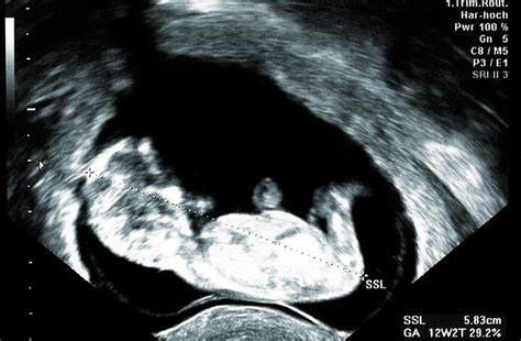 Ultrazvukový snímok embrya v 6. týždni tehotenstva so zobrazením srdcovej akcie