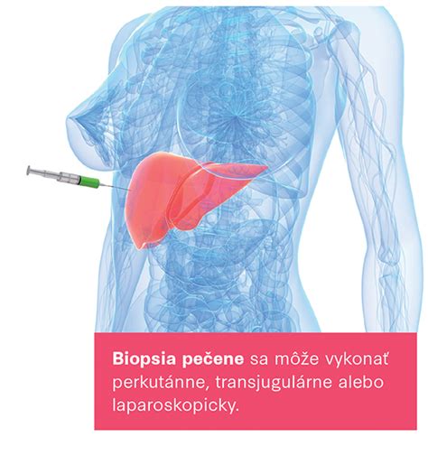 Diagram zobrazujúci štádiá cirhózy pečene
