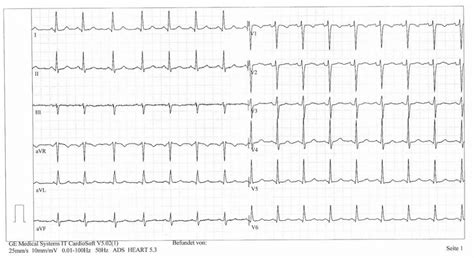 EKG záznam