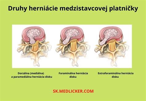 Diagram znázorňujúci štádiá hernie disku: normálna platnička, protrúzia, extrúzia