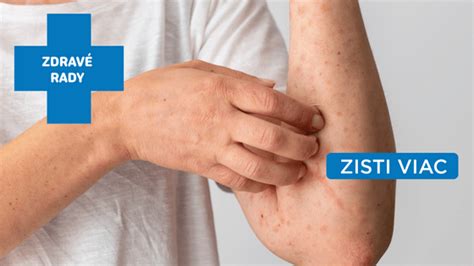 Ilustrácia alergickej reakcie na koži