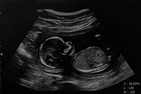 ultrazvuk embrya v 8. týždni