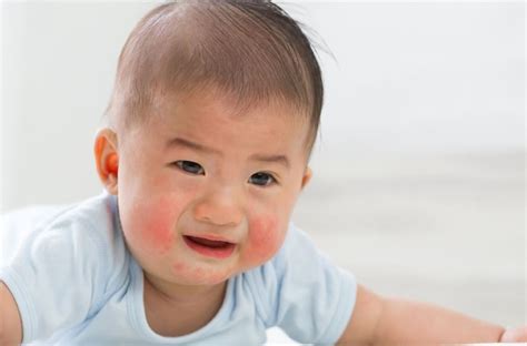 Ilustrácia dieťaťa s vyrážkou