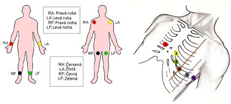 Diagram znázorňujúci umiestnenie elektród na hrudi pre Holter EKG