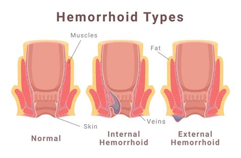 Diagram ukazujúci štyri štádiá hemoroidov
