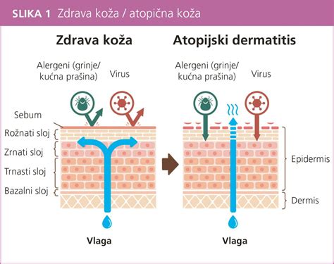 Štádiá vyrážky pri ovčích kiahňach: makula, papula, vezikula, chrasta
