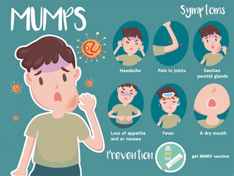 Ilustrácia opuchnutých príušných žliaz pri mumps