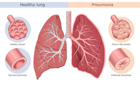 Diagram ľudských pľúc s vyznačenými oblasťami postihnutými zápalom