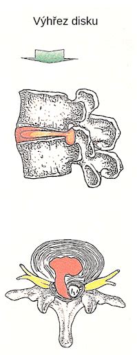 Ilustrácia znázorňujúca vyklenutie pri pupočnej hernii