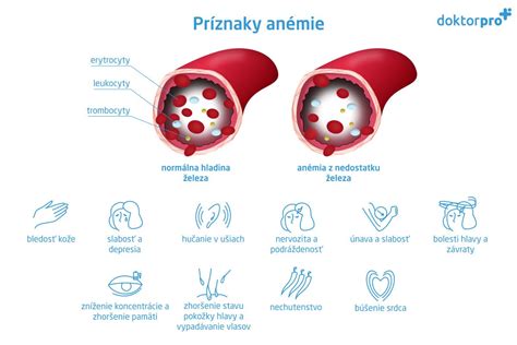 Infografika: Príznaky nedostatku železa