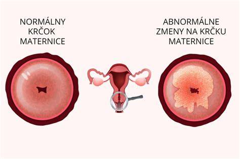 Ilustrácia krčka maternice počas tehotenstva s hlienovou zátkou