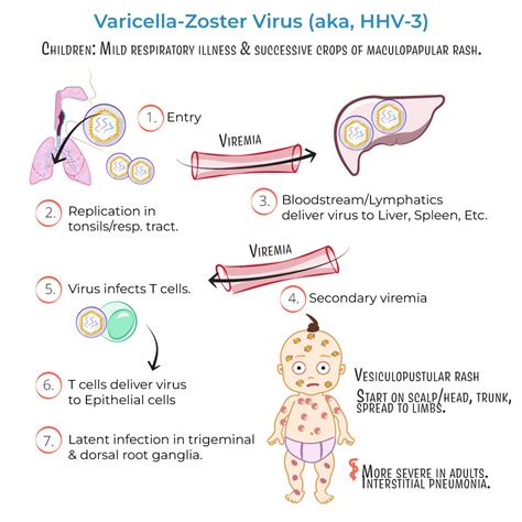 Infografika zobrazujúca proces reaktivácie vírusu varicella zoster