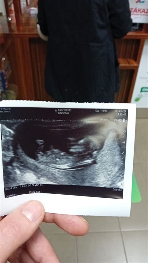 Ultrazvuk bábätka v maternici