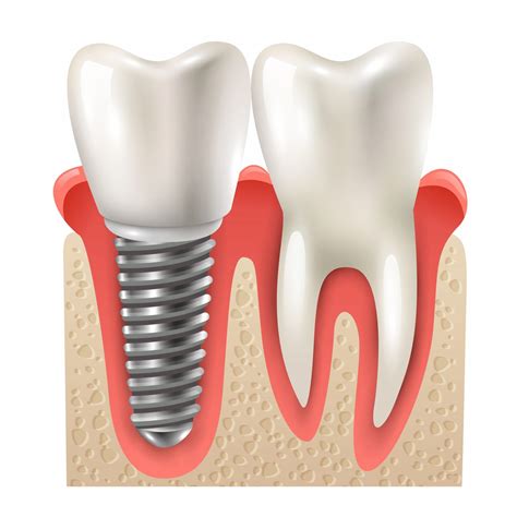 Diagram zobrazujúci proces zavedenia zubných implantátov